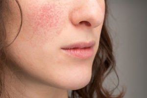 A close-up of an allergic reaction on a woman’s face