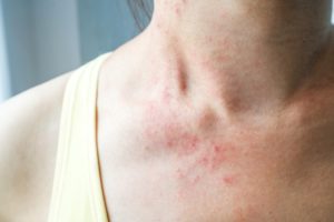 A woman’s neck shows an allergic reaction