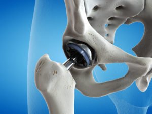 3D render of hip replacement