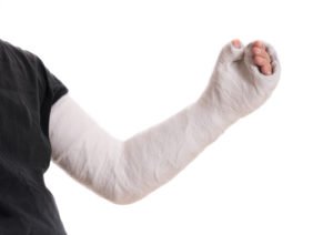 man in an arm cast