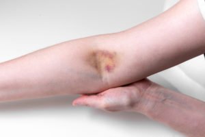 person with an arm bruise